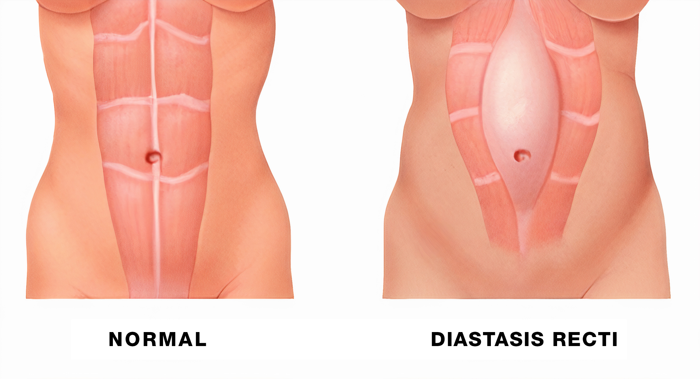 What Is A Diastasis Recti And How Do I Fix It? - National Association For  Continence